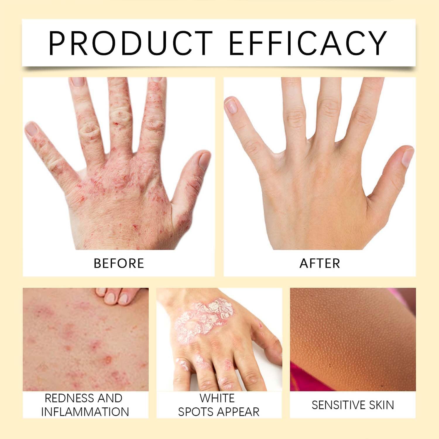 Bee Venom Vitiligo Cream, Beevenom Vitiligo Treatment Cream for All Skin Types