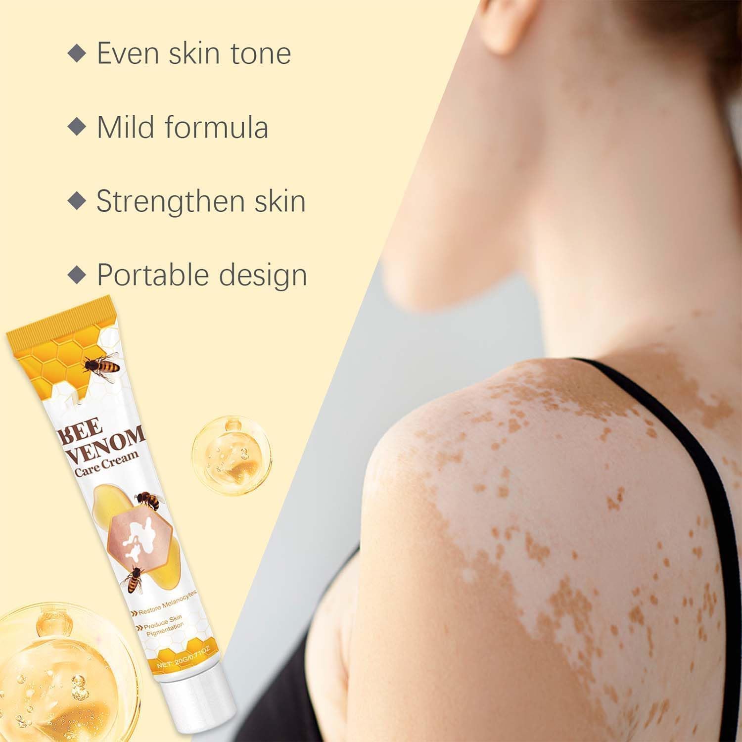 Bee Venom Vitiligo Cream, Beevenom Vitiligo Treatment Cream for All Skin Types