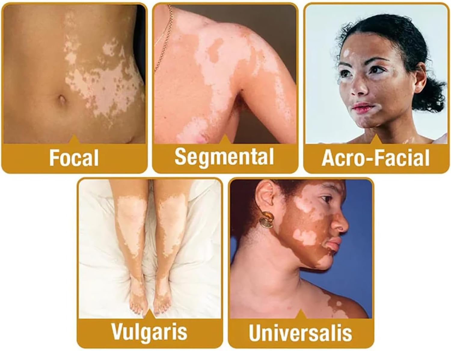 Bee Venom Vitiligo Cream, Beevenom Vitiligo Treatment Cream for All Skin Types
