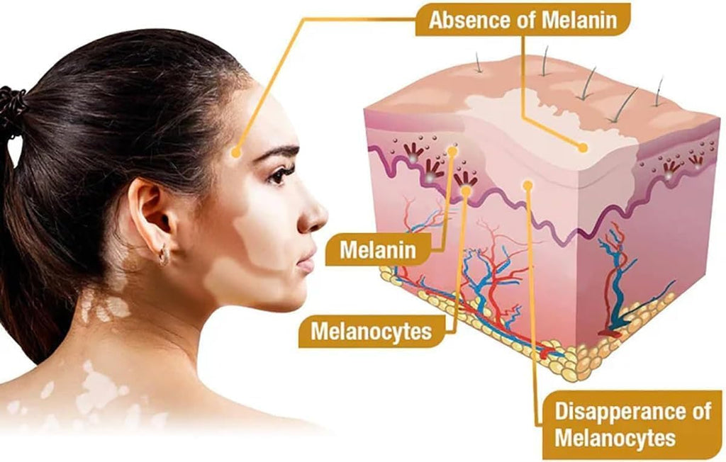 Bee Venom Vitiligo Cream, Beevenom Vitiligo Treatment Cream for All Skin Types