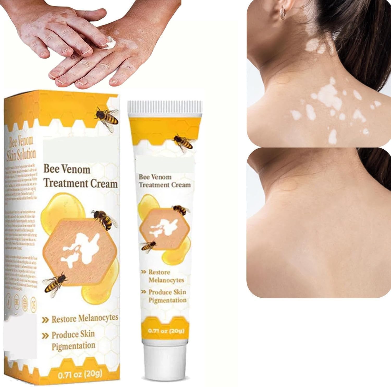 Bee Venom Vitiligo Cream, Beevenom Vitiligo Treatment Cream for All Skin Types